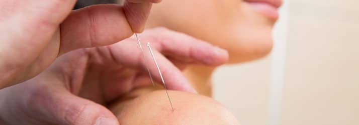 Acupuncture Chesterfield MO Acupuncture